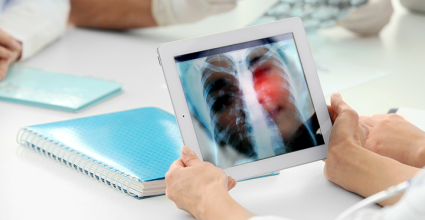 Moovecare - detection cancer poumon