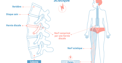 Sciatique, comment se soigner